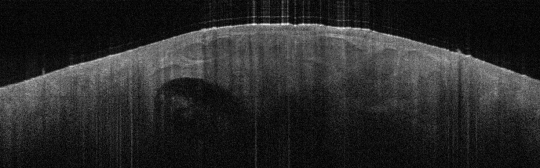 P_VA115_S_835_24-Apr-2012_11.40.49_OCT_Scan