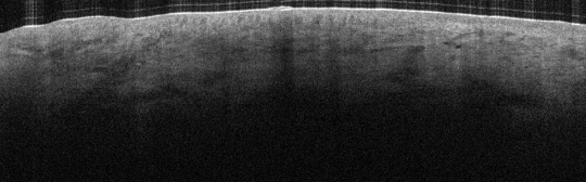 P_VA121_S_863_30-Apr-2012_14.42.30_OCT_Scan.1