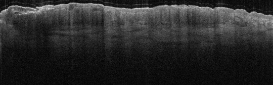 P_VA133_S_921_08-May-2012_11.11.48_OCT_Scan