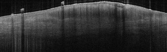 P_VA150_S_1019_22-May-2012_09.30.35_OCT_Scan