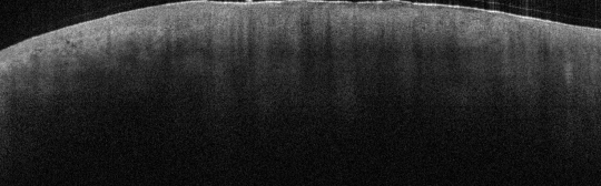 P_VA155_S_1042_22-May-2012_10.55.52_OCT_Scan