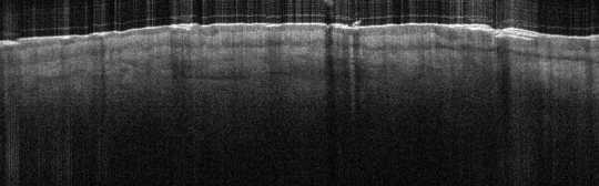 P_VA15_S_231_23-Jan-2012_14.11.39_OCT_Normal_Adjacent_Skin