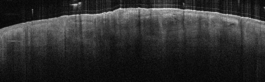 P_VA71_S_595_03-Apr-2012_11.18.33_OCT_Scan.1