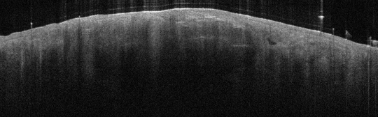 P_VA94_S_721_17-Apr-2012_10.00.07_OCT_Scan