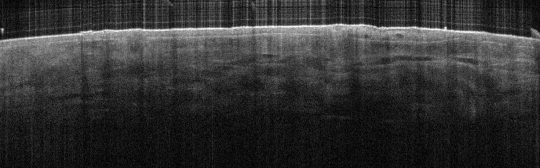 P_VA97_S_738_17-Apr-2012_13.57.03_OCT_LESION