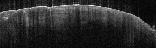 P_VA9_S_208_19-Jan-2012_15.45.01_OCT_L_Upper_Forearm